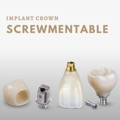 Screwmentable Implant Crowns (2)